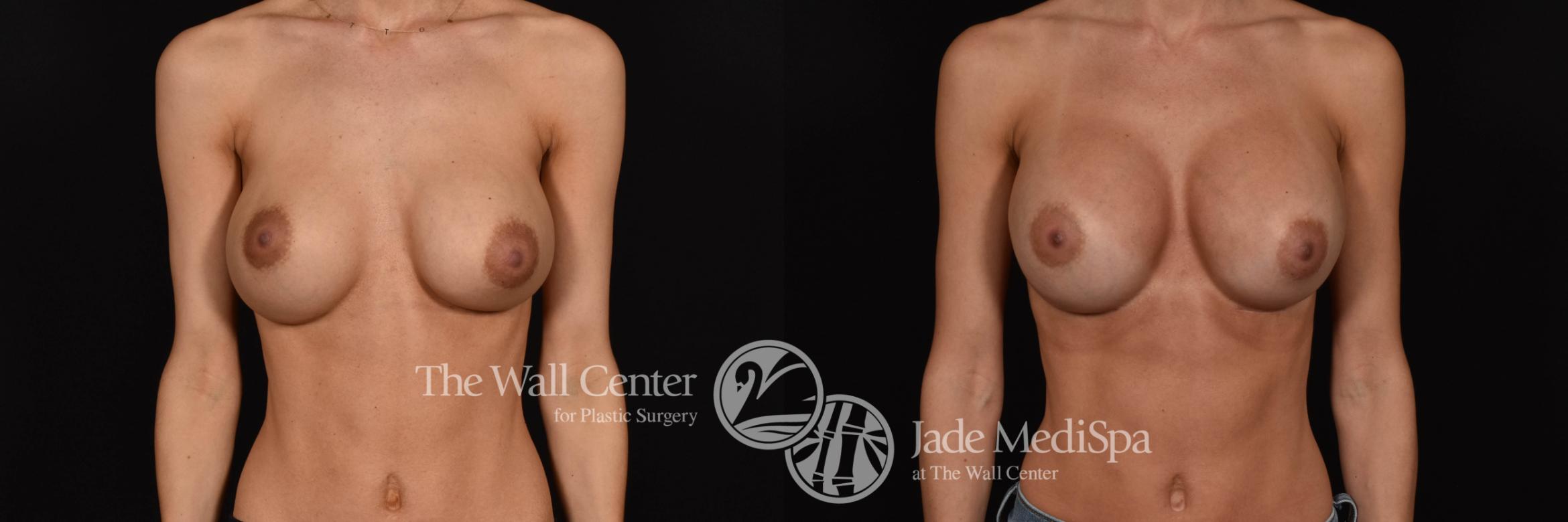 Breast Implant Exchange Front Photo, Shreveport, Louisiana, The Wall Center for Plastic Surgery, Case 880
