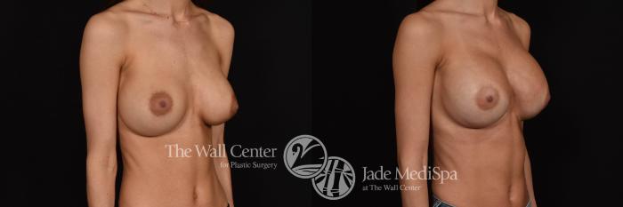 Breast Implant Exchange Right Oblique Photo, Shreveport, Louisiana, The Wall Center for Plastic Surgery, Case 880
