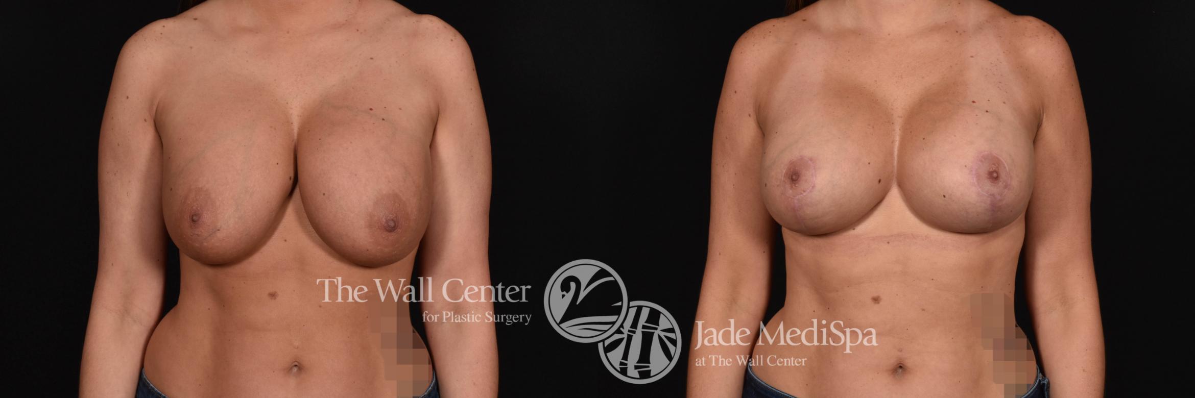 Breast Implant Exchange Front Photo, Shreveport, Louisiana, The Wall Center for Plastic Surgery, Case 884