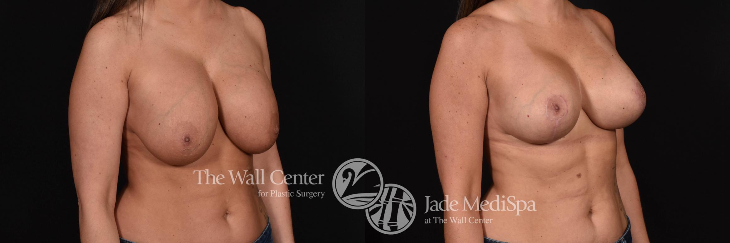 Breast Implant Exchange Right Oblique Photo, Shreveport, Louisiana, The Wall Center for Plastic Surgery, Case 884