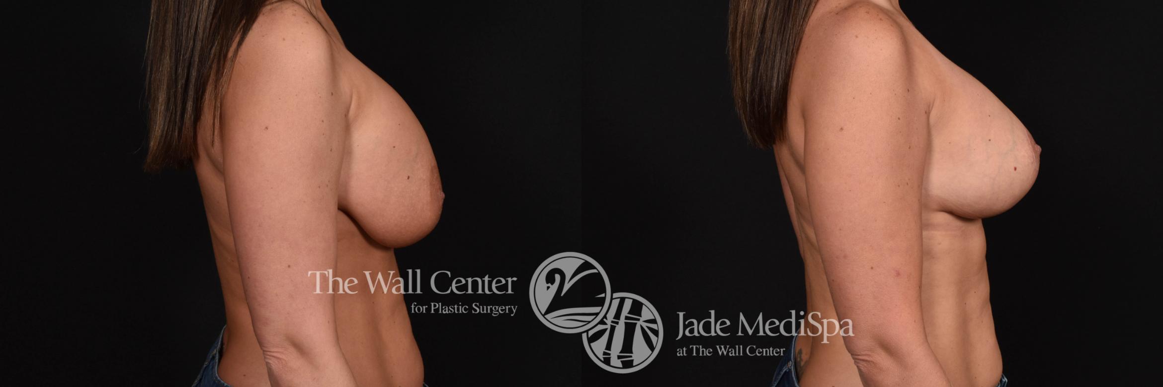 Breast Implant Exchange Right Side Photo, Shreveport, Louisiana, The Wall Center for Plastic Surgery, Case 884