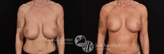 Breast Implant Exchange with Lift Front Photo, Shreveport, Louisiana, The Wall Center for Plastic Surgery, Case 894