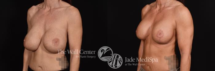 Breast Implant Exchange with Lift Left Oblique Photo, Shreveport, Louisiana, The Wall Center for Plastic Surgery, Case 894