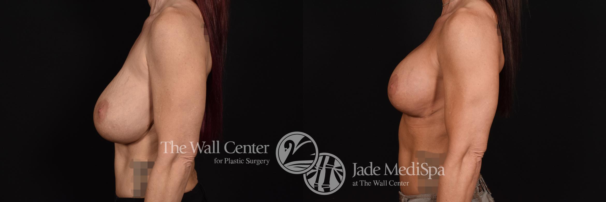 Breast Implant Exchange with Lift Left Side Photo, Shreveport, Louisiana, The Wall Center for Plastic Surgery, Case 894