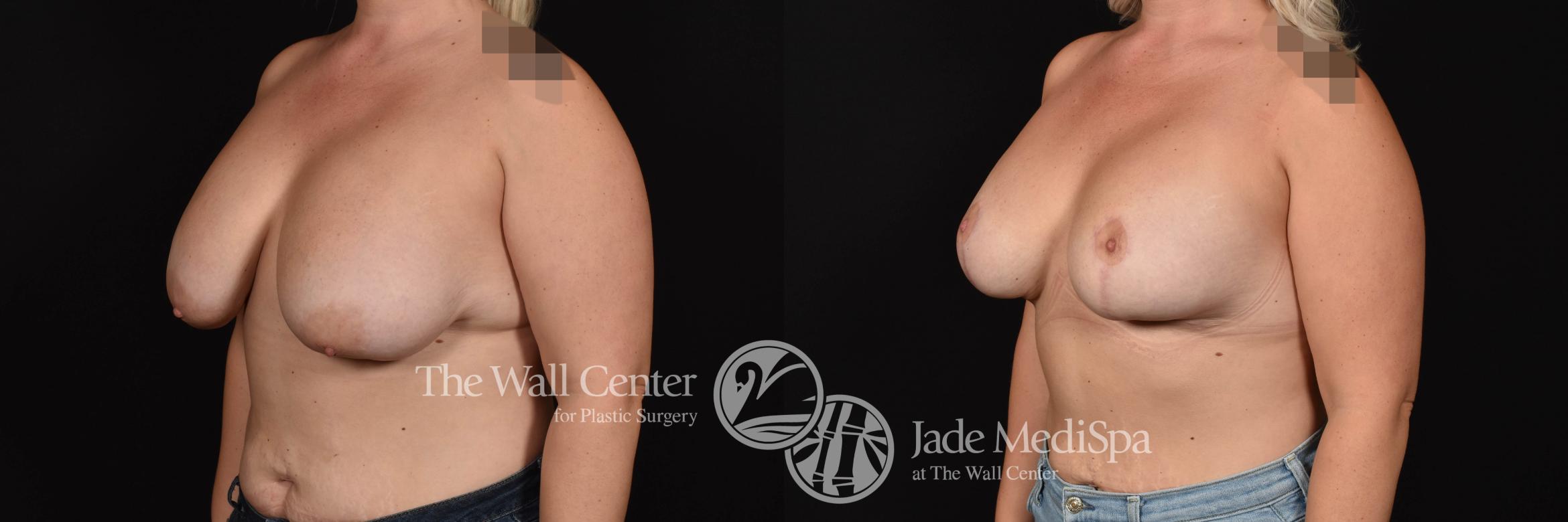 Breast Implant Exchange Left Oblique Photo, Shreveport, Louisiana, The Wall Center for Plastic Surgery, Case 915