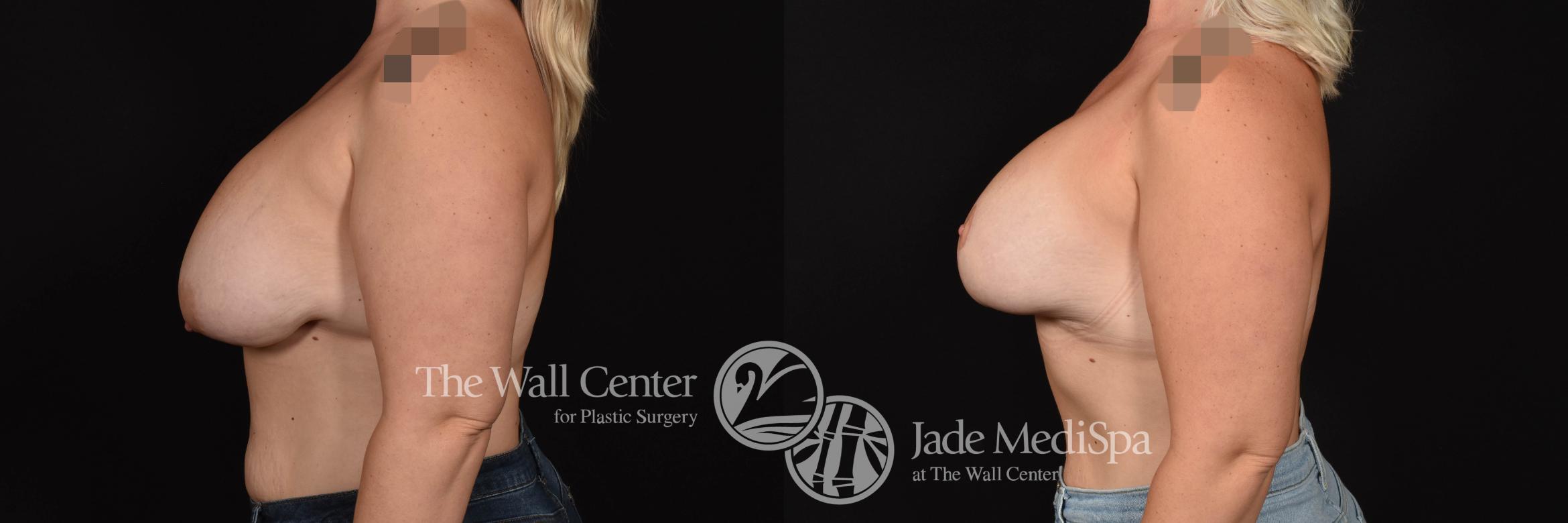 Breast Implant Exchange Left Side Photo, Shreveport, Louisiana, The Wall Center for Plastic Surgery, Case 915