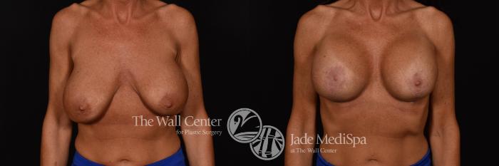 Breast Implant Exchange Front Photo, Shreveport, Louisiana, The Wall Center for Plastic Surgery, Case 964