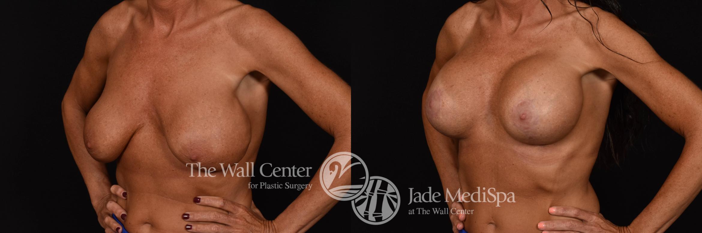 Breast Implant Exchange Left Oblique Shape Photo, Shreveport, Louisiana, The Wall Center for Plastic Surgery, Case 964