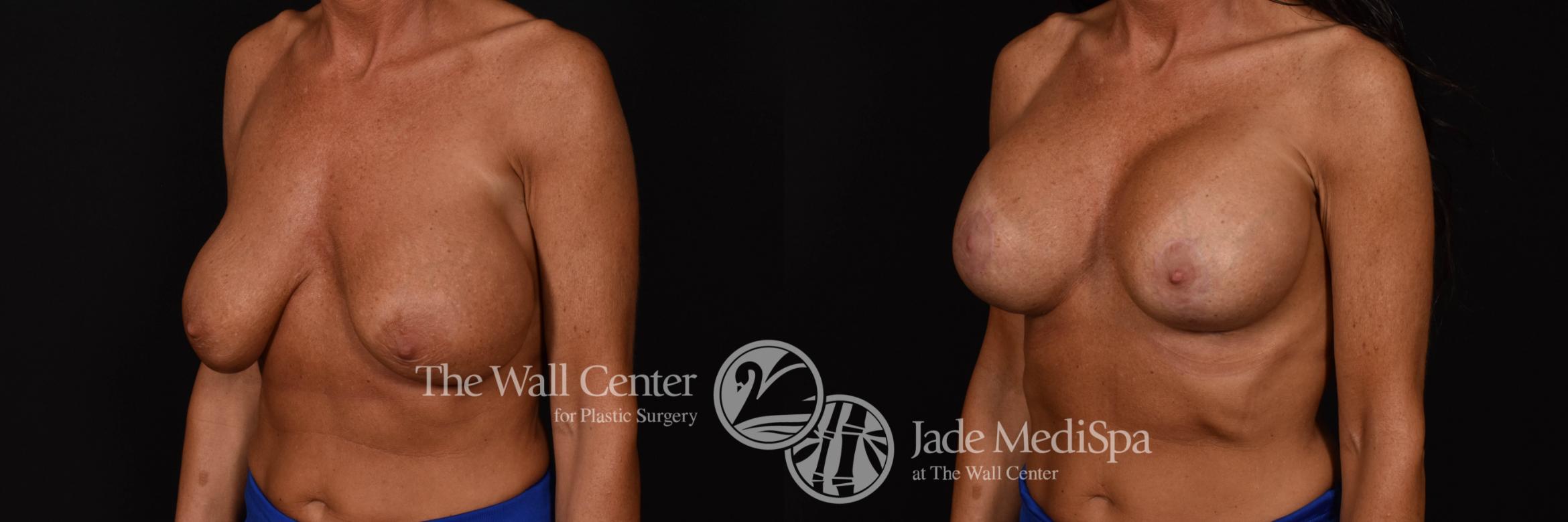 Breast Implant Exchange Left Oblique Photo, Shreveport, Louisiana, The Wall Center for Plastic Surgery, Case 964