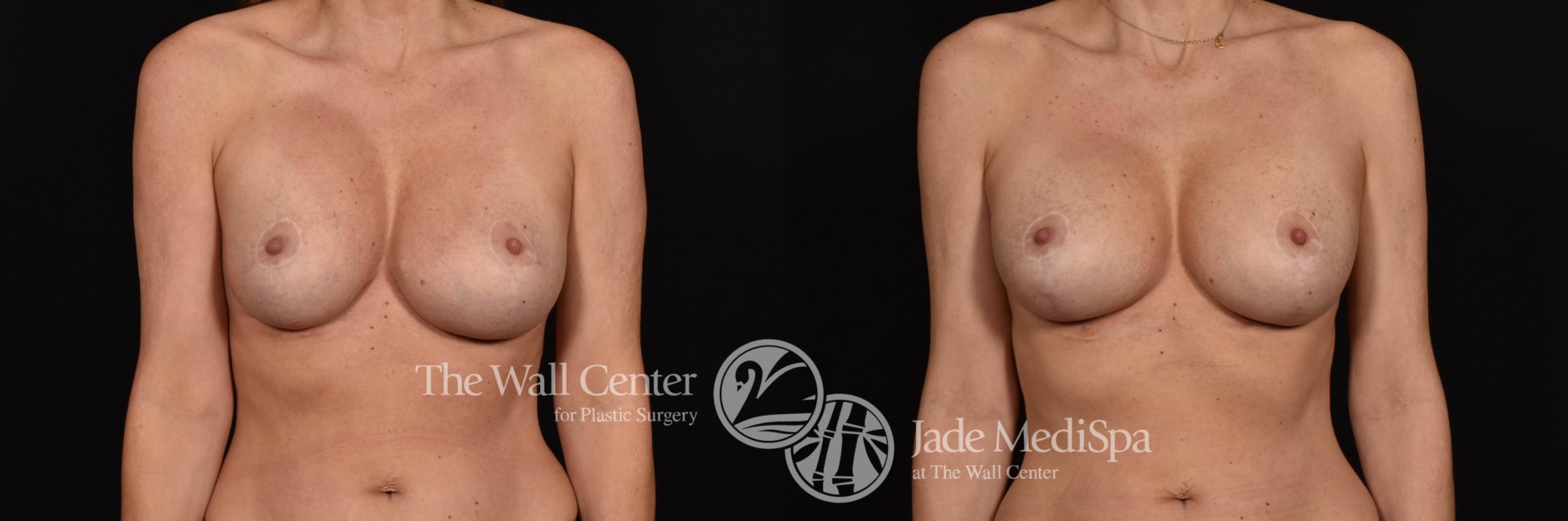 Breast Implant Exchange with Pocket Revision and Capsulectomy