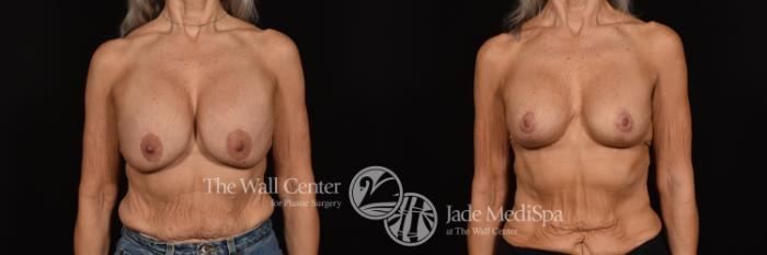 Before & After Breast Implant Exchange Case 998 Front View in Shreveport, LA