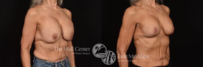 Before & After Breast Implant Exchange Case 998 Right Oblique View in Shreveport, LA
