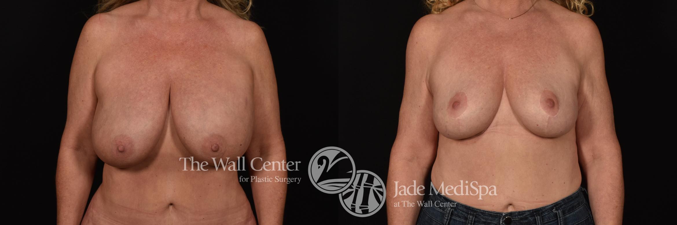 Before & After Breast Lift Case 1046 Front View in Shreveport, LA