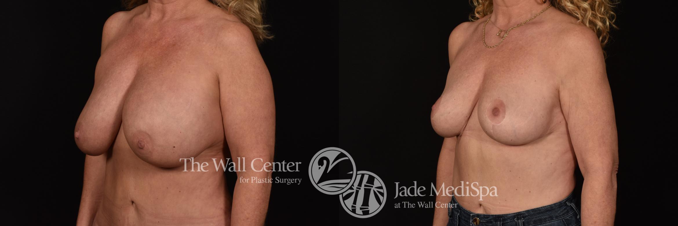 Before & After Redo Surgery/Problem Cases Case 1046 Left Oblique View in Shreveport, LA