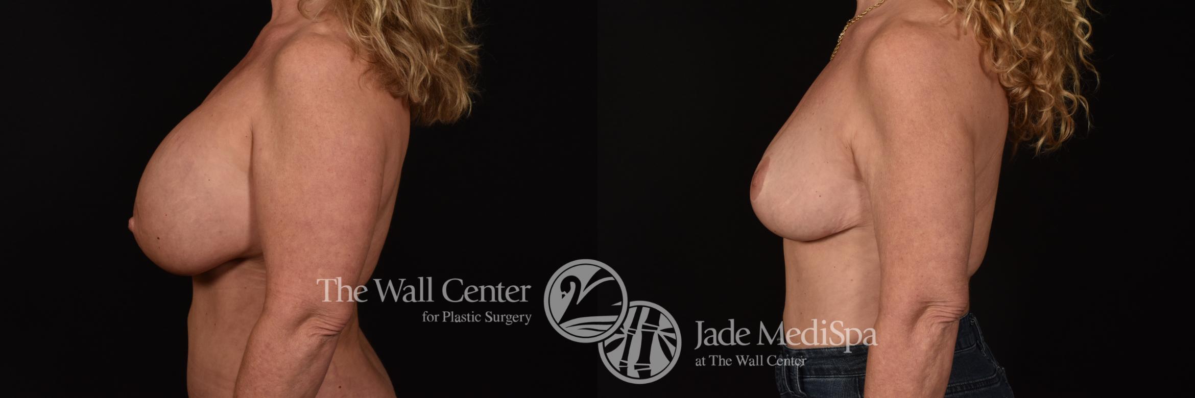 Before & After Redo Surgery/Problem Cases Case 1046 Left Side View in Shreveport, LA
