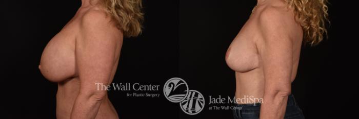 Before & After Redo Surgery/Problem Cases Case 1046 Left Side View in Shreveport, LA