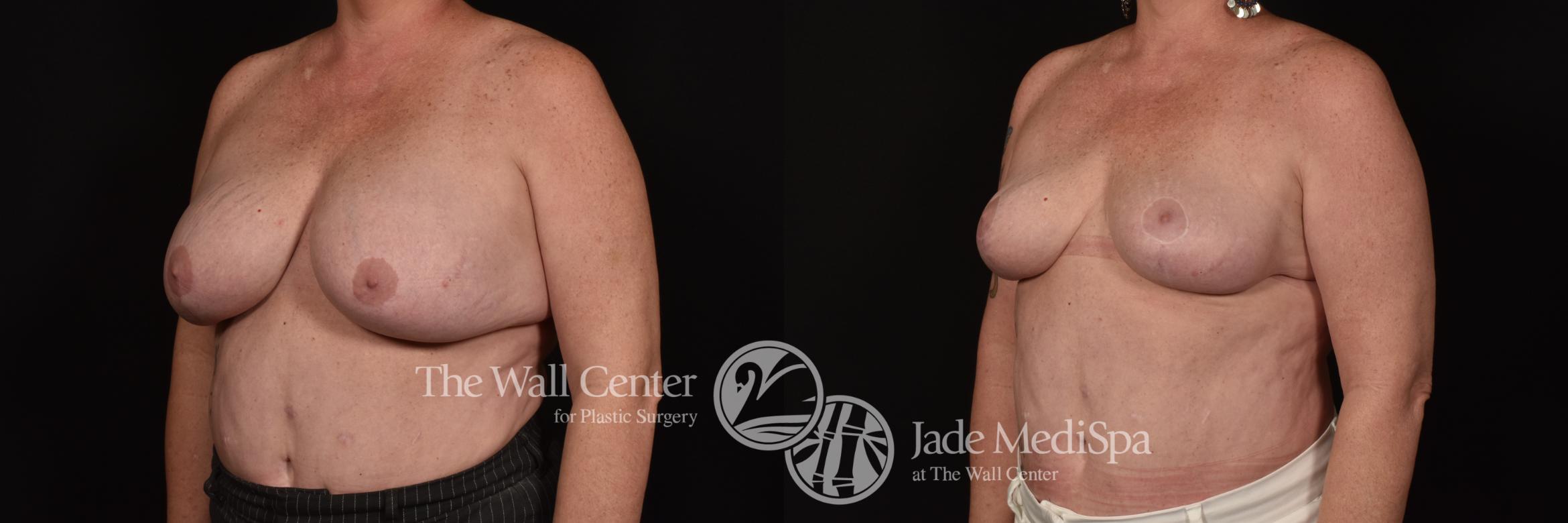 Before & After Breast Lift Case 1110 Left Oblique View in Shreveport, LA