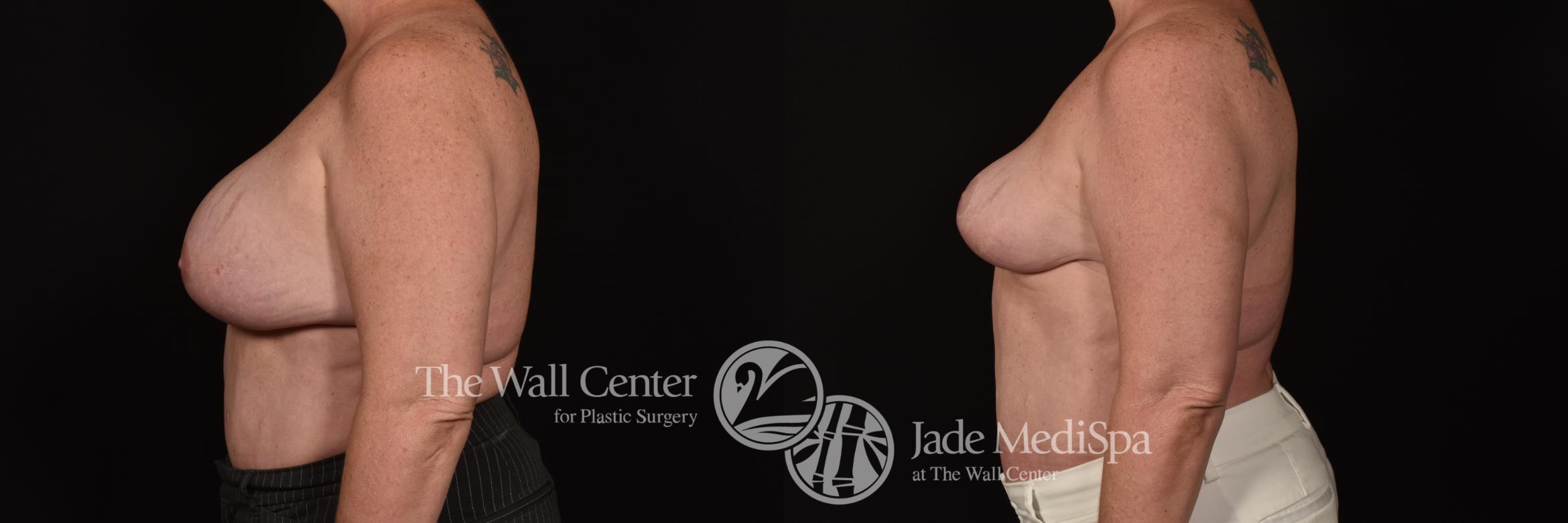 Before & After Breast Lift Case 1110 Left Side View in Shreveport, LA