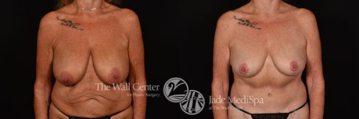 Before & After Breast Lift Case 1170 Front View in Shreveport, LA
