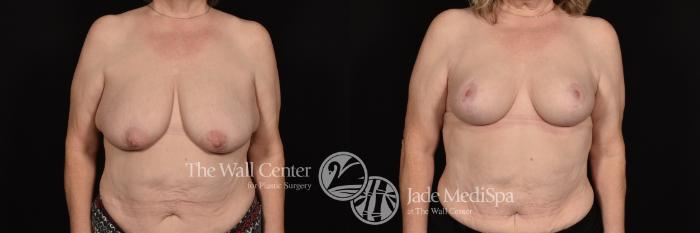 Before & After Breast Lift Case 1192 Front View in Shreveport, LA