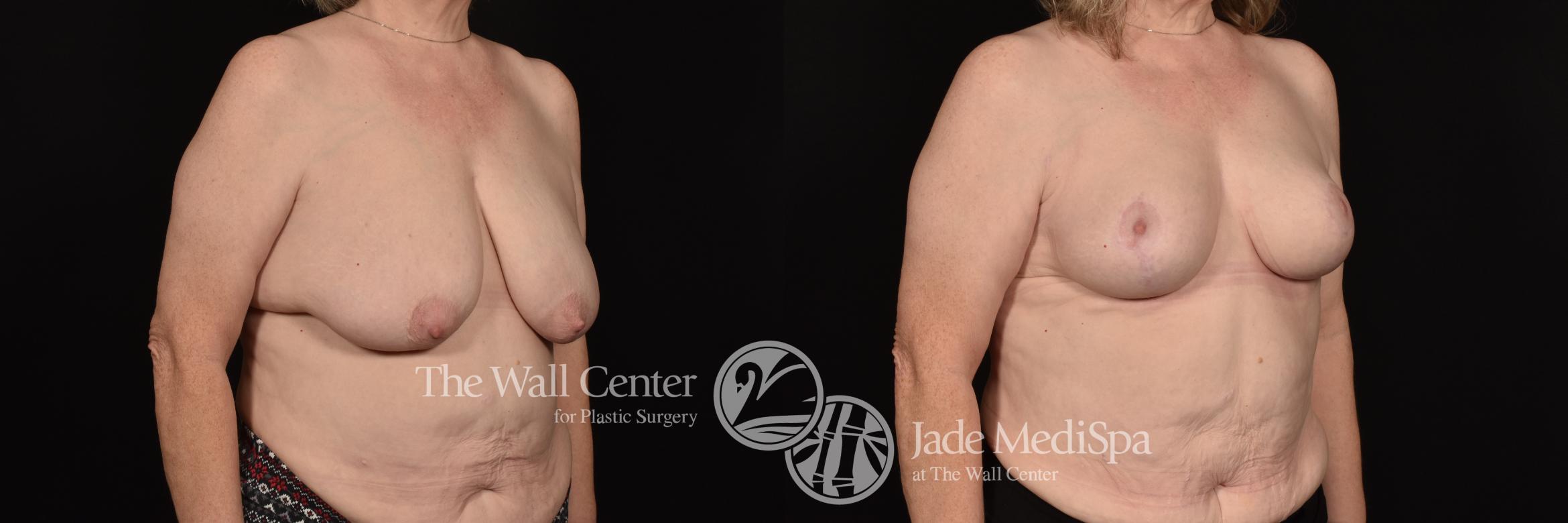 Before & After Breast Lift Case 1192 Right Oblique View in Shreveport, LA