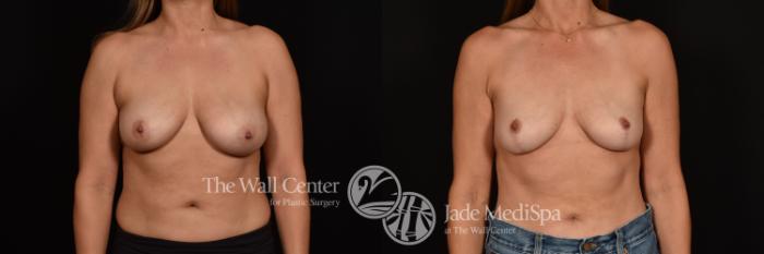 Before & After Breast Lift Case 1193 Front View in Shreveport, LA