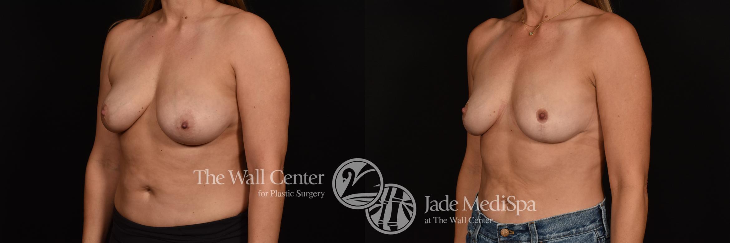 Before & After Breast Lift Case 1193 Left Oblique View in Shreveport, LA
