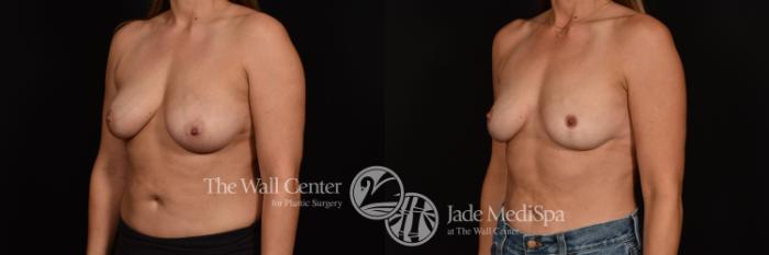 Before & After Breast Lift Case 1193 Left Oblique View in Shreveport, LA