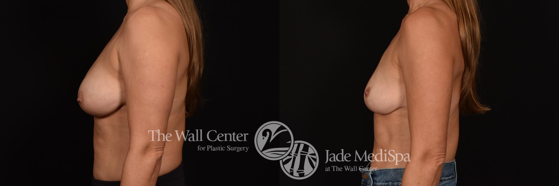 Before & After Breast Lift Case 1193 Left Side View in Shreveport, LA