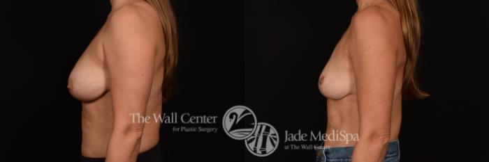 Before & After Breast Lift Case 1193 Left Side View in Shreveport, LA