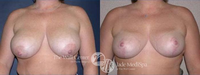 Before & After Breast Lift Case 121 View #1 View in Shreveport, LA