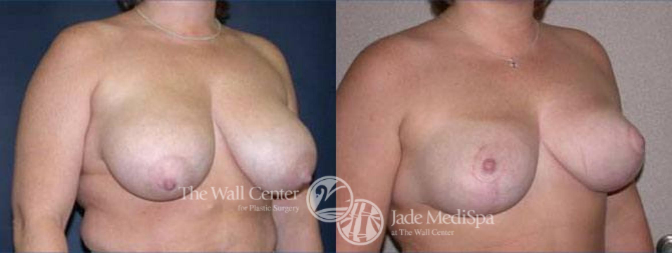 Before & After Breast Lift Case 121 View #2 View in Shreveport, LA