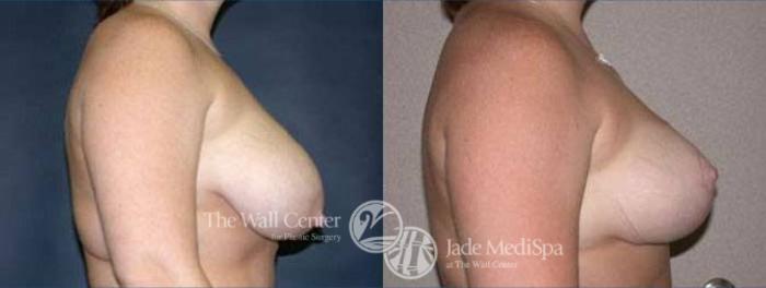 Before & After Breast Lift Case 121 View #3 View in Shreveport, LA