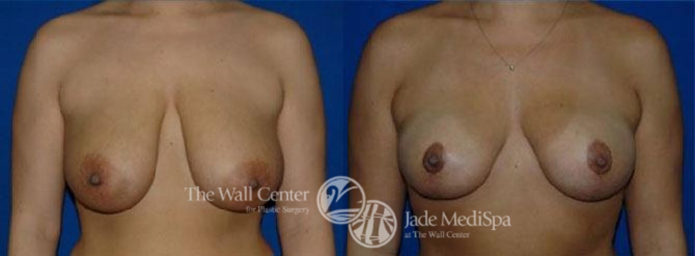 Breast Lift Case 123 Before & After View #1 | Shreveport, LA | The Wall Center
