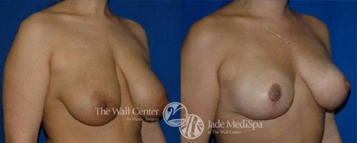 Before & After Breast Lift Case 123 View #2 View in Shreveport, LA
