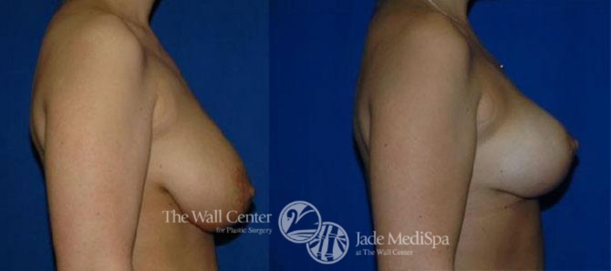 Breast Lift Case 123 Before & After View #3 | Shreveport, LA | The Wall Center