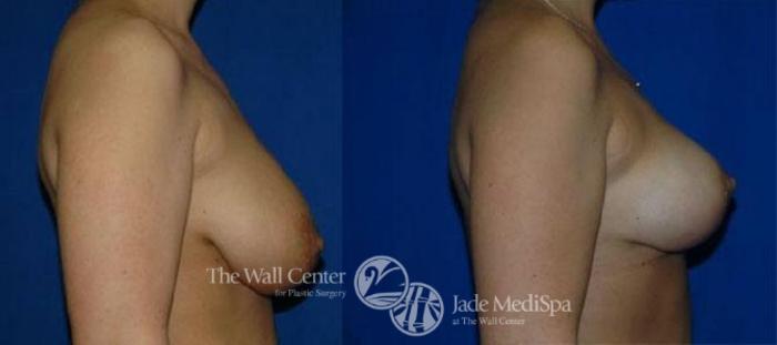 Before & After Breast Lift Case 123 View #3 View in Shreveport, LA