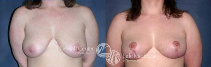 Before & After Breast Lift Case 124 View #1 View in Shreveport, LA