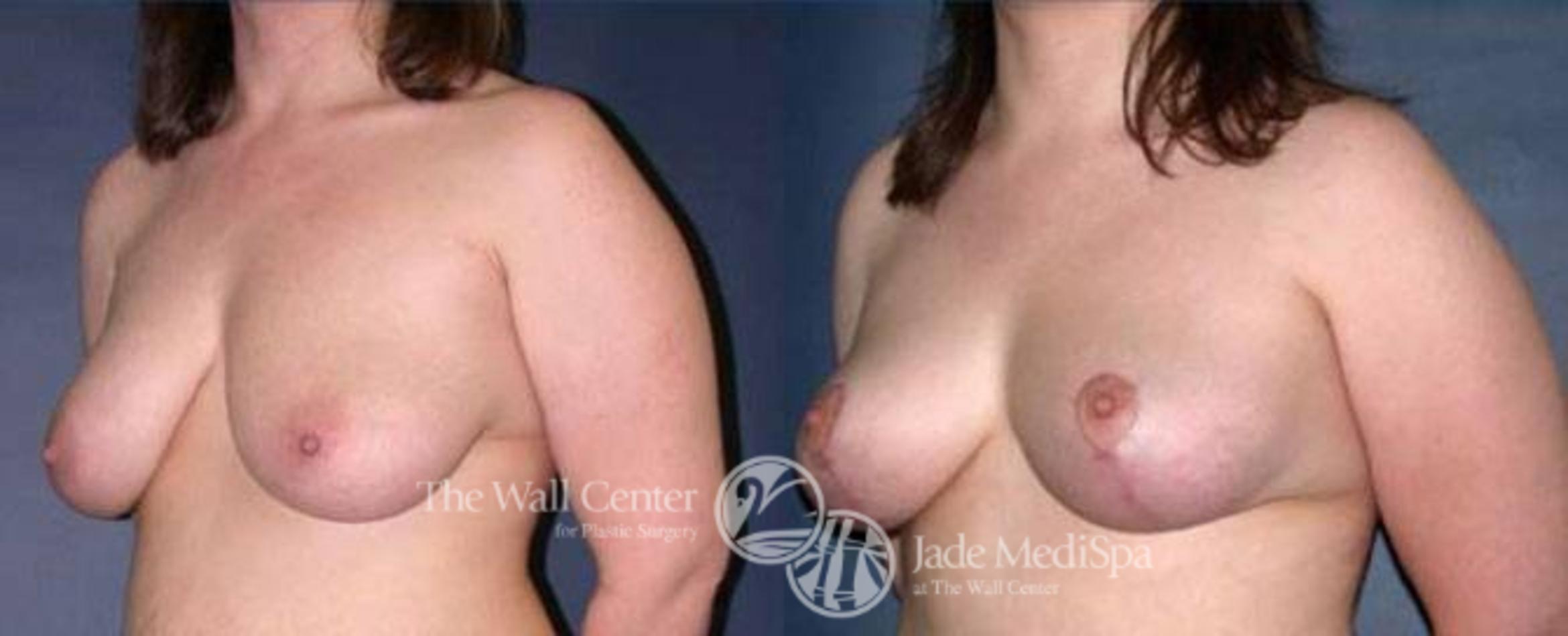 Before & After Breast Lift Case 124 View #2 View in Shreveport, LA