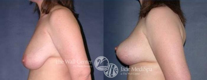 Before & After Breast Lift Case 124 View #3 View in Shreveport, LA