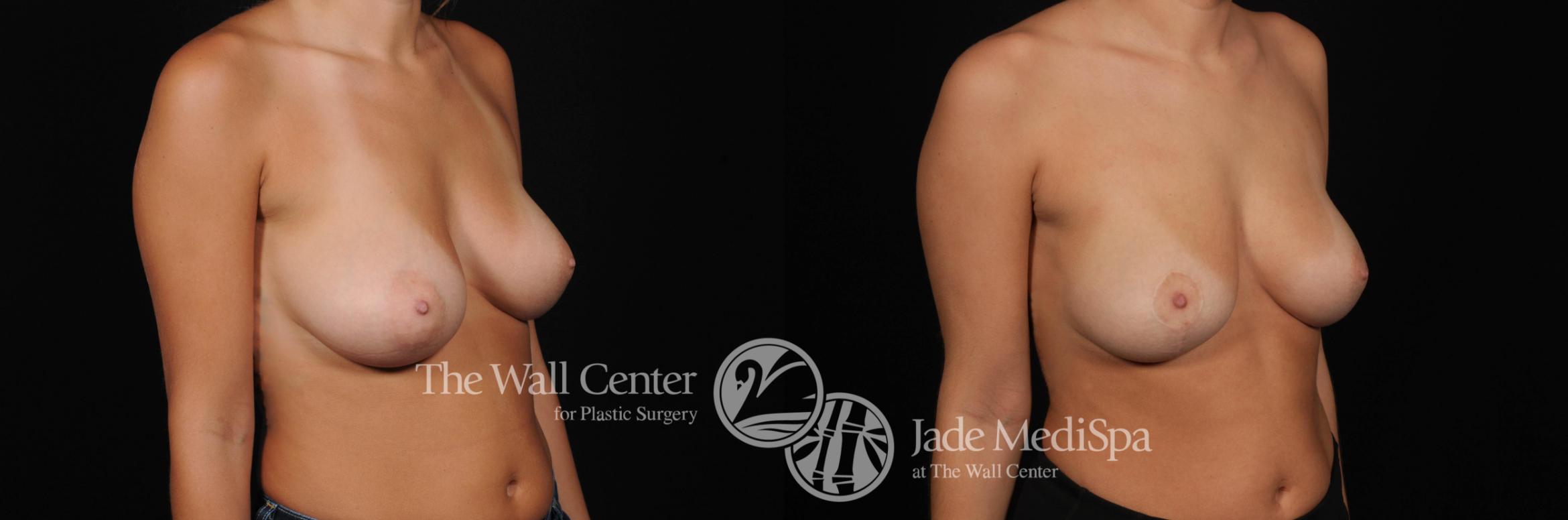 Before & After Breast Lift Case 544 View #2 View in Shreveport, LA
