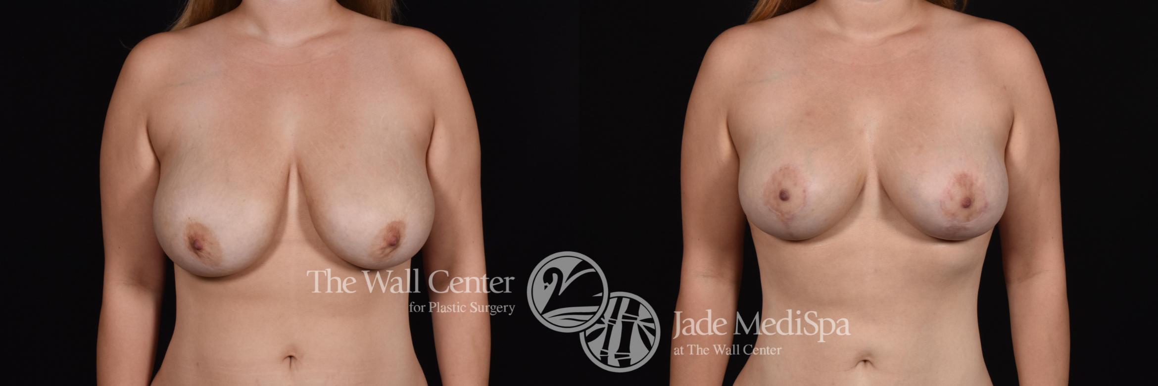 Before & After Breast Lift Case 563 View #1 View in Shreveport, LA