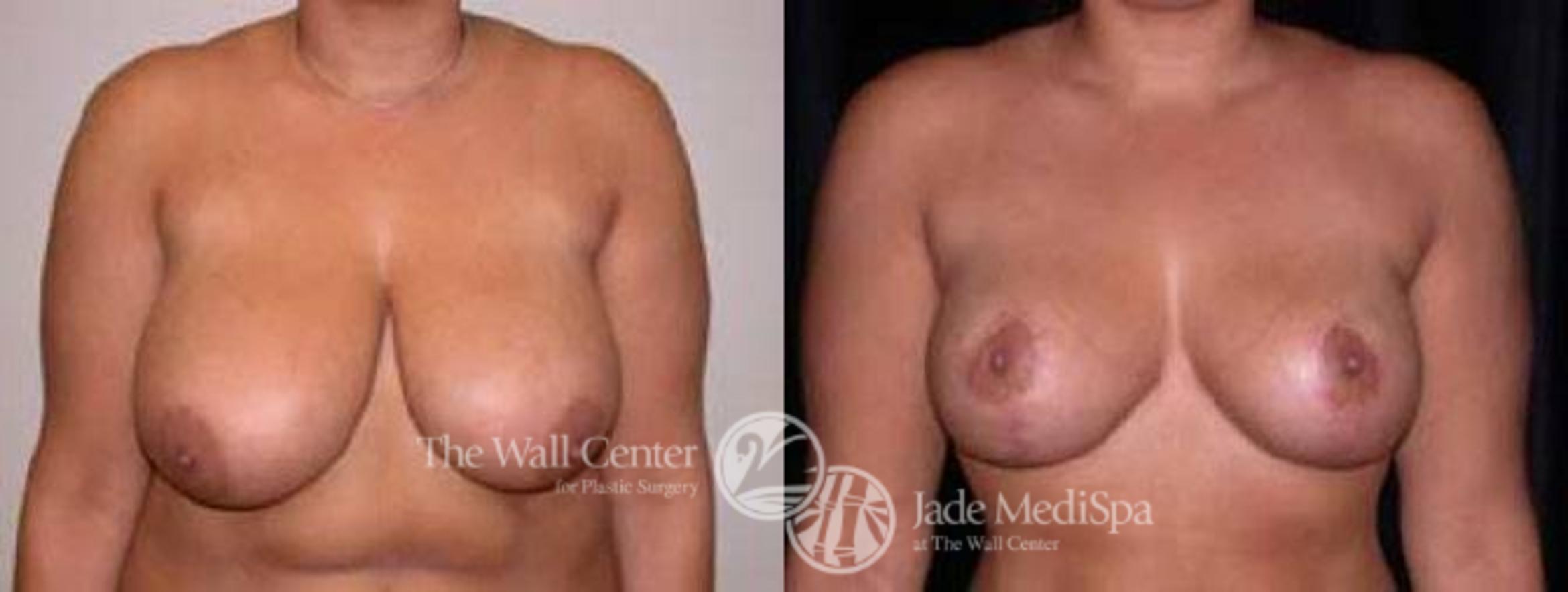 Breast Lift Case 64 Before & After View #1 | Shreveport, LA | The Wall Center