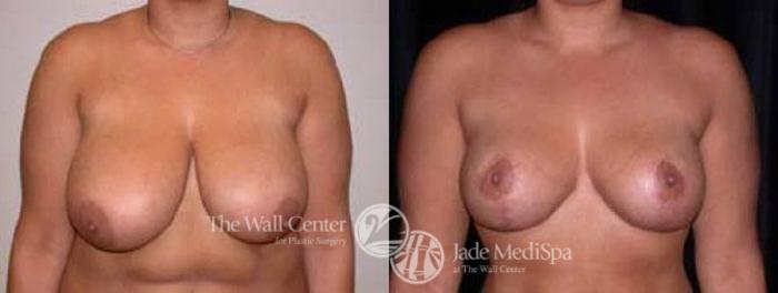 Before & After Breast Lift Case 64 View #1 View in Shreveport, LA