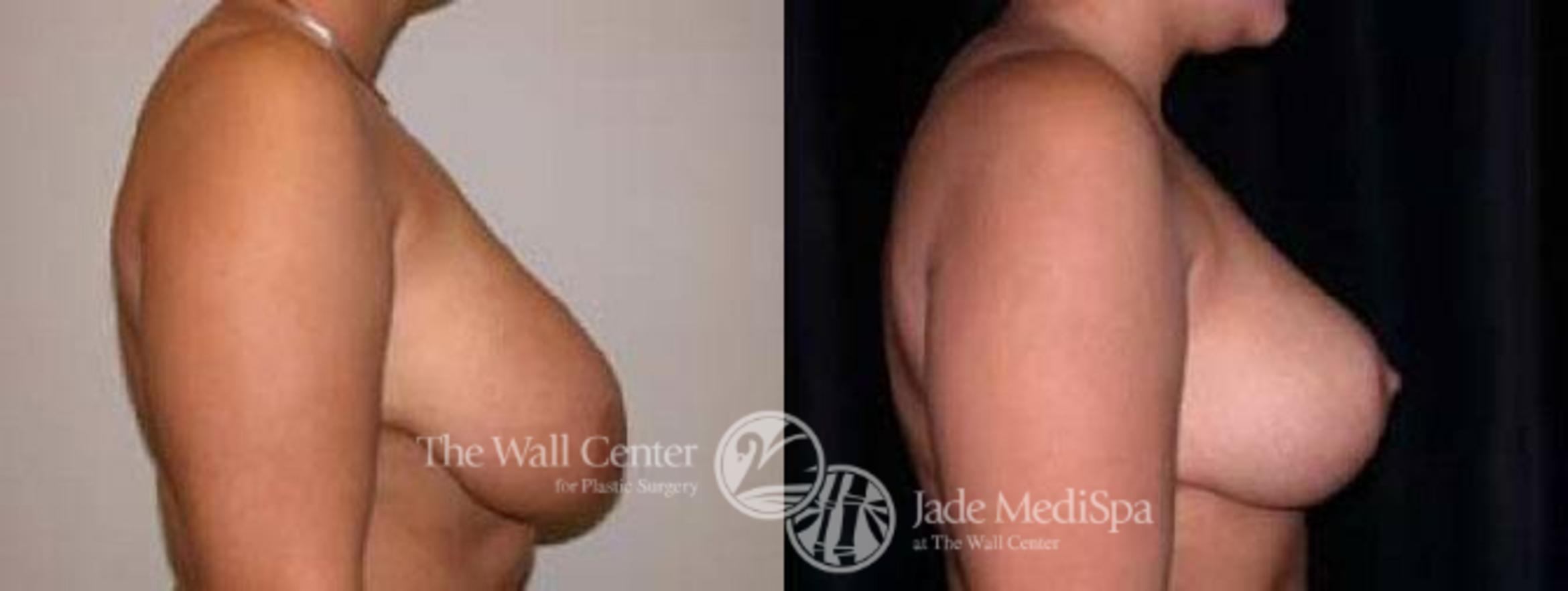 Before & After Breast Lift Case 64 View #3 View in Shreveport, LA