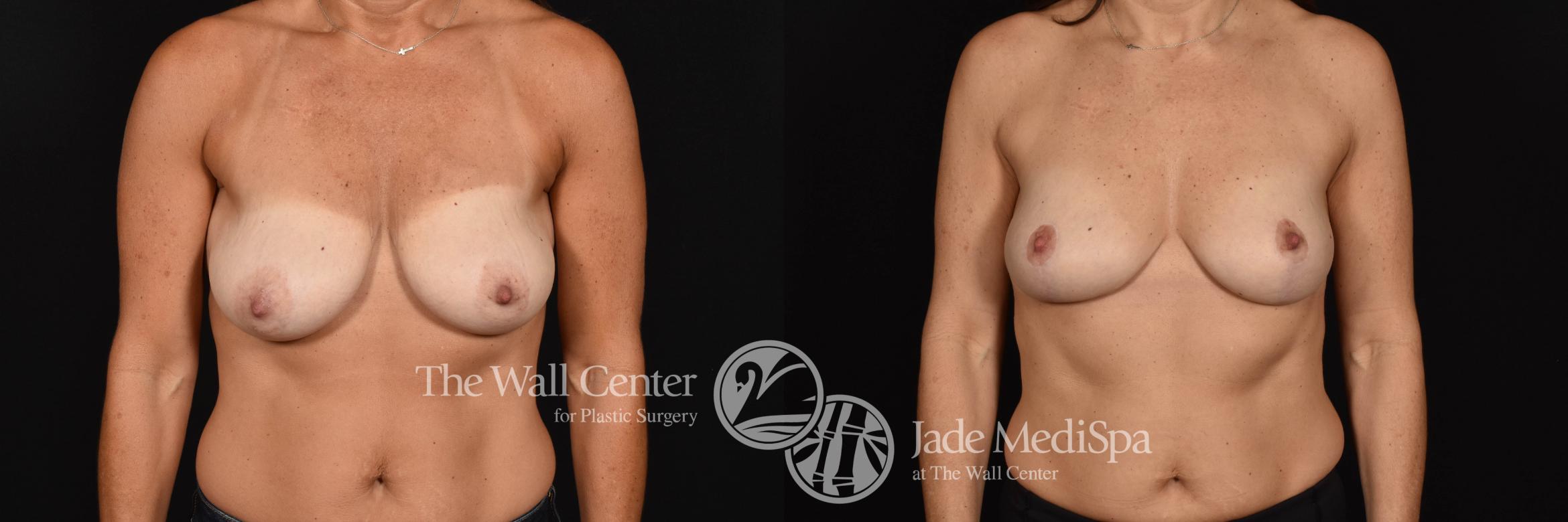 Breast Left Front Photo, Shreveport, Louisiana, The Wall Center for Plastic Surgery, Case 892