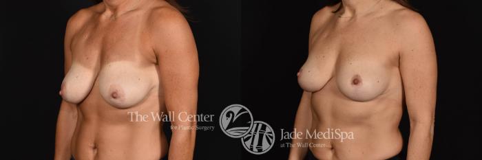 Breast Left Left Oblique Photo, Shreveport, Louisiana, The Wall Center for Plastic Surgery, Case 892