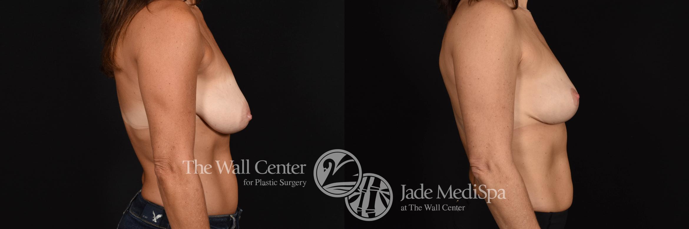 Breast Left Right Side Photo, Shreveport, Louisiana, The Wall Center for Plastic Surgery, Case 892