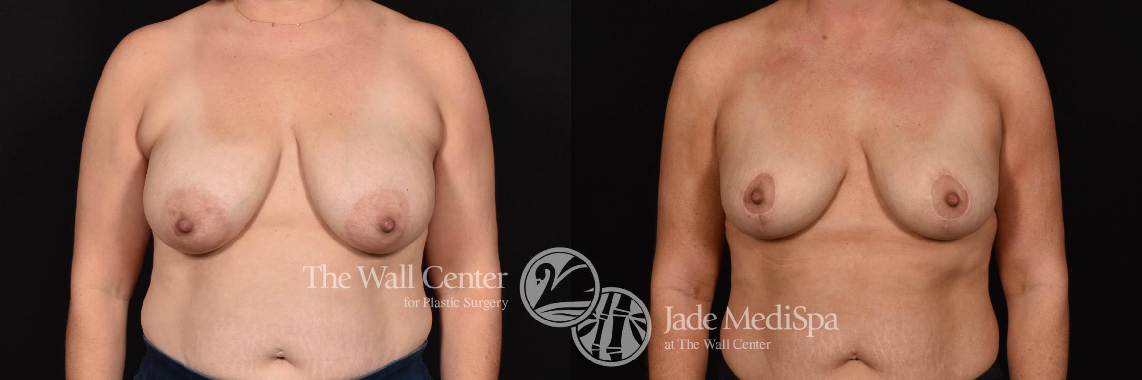 Breast Lift with SAFELipo & Fat Grafting Front Photo, Shreveport, Louisiana, The Wall Center for Plastic Surgery, Case 960
