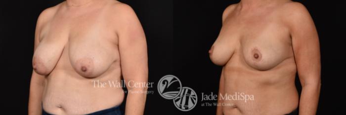 Breast Lift with SAFELipo & Fat Grafting Left Oblique Photo, Shreveport, Louisiana, The Wall Center for Plastic Surgery, Case 960